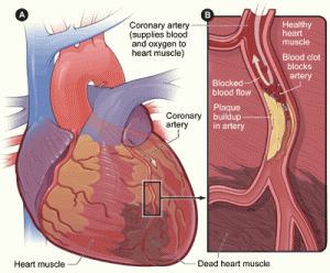 Heart_Attack