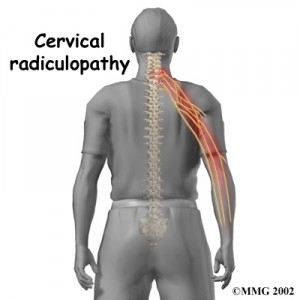 cervical_radiculopathy