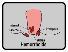 hemorrhoids